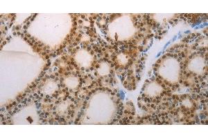 Immunohistochemistry of paraffin-embedded Human thyroid cancer tissue using S100A1 Polyclonal Antibody at dilution 1:70 (S100A1 Antikörper)