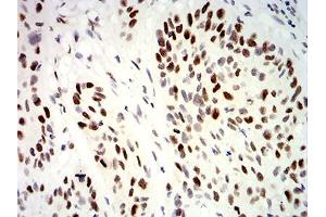 Immunohistochemical analysis of paraffin-embedded esophageal cancer tissues using UHRF1 mouse mAb with DAB staining.