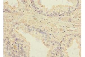 Immunohistochemistry of paraffin-embedded human prostate cancer using ABIN7171878 at dilution of 1:100 (TSPAN4 Antikörper  (AA 107-201))