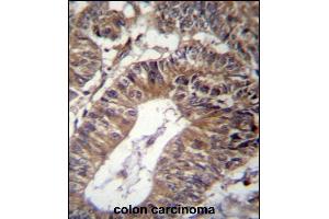 GCC1 Antibody (C-term) (ABIN656908 and ABIN2846105) immunohistochemistry analysis in formalin fixed and paraffin embedded human colon carcinoma followed by peroxidase conjugation of the secondary antibody and DAB staining. (GCC1 Antikörper  (C-Term))