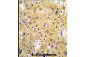 Formalin-fixed and paraffin-embedded human hepatocarcinoma tissue reacted with ECGF1 antibody , which was peroxidase-conjugated to the secondary antibody, followed by DAB staining. (Thymidine Phosphorylase Antikörper  (AA 318-345))