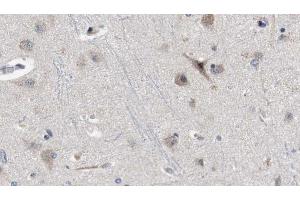 ABIN6272329 at 1/100 staining Human brain cancer tissue by IHC-P.
