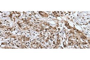 Immunohistochemistry of paraffin-embedded Human gastric cancer tissue using UPK3A Polyclonal Antibody at dilution of 1:30(x200) (Uroplakin 3A Antikörper)