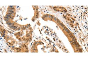 Immunohistochemistry of paraffin-embedded Human colon cancer tissue using HTR3A Polyclonal Antibody at dilution 1:50 (Serotonin Receptor 3A Antikörper)
