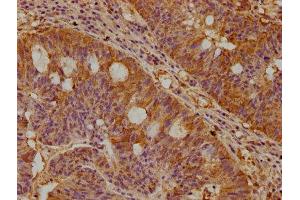 IHC image of ABIN7169092 diluted at 1:300 and staining in paraffin-embedded human pancreatic cancer performed on a Leica BondTM system.