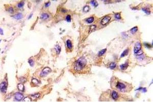Immunohistochemistry (IHC) analyzes of p-eIF4E in paraffin-embedded human breast carcinoma tissue. (EIF4E Antikörper  (pSer209))