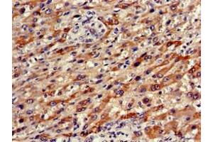 Immunohistochemistry of paraffin-embedded human liver cancer using ABIN7161673 at dilution of 1:100 (Olfactomedin 1 Antikörper  (AA 374-441))