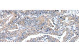 Immunohistochemistry of paraffin-embedded Human esophagus cancer using RAB2A Polyclonal Antibody at dilution of 1/40 (RAB2A Antikörper)
