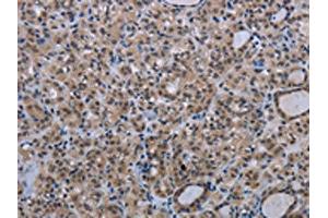 The image on the left is immunohistochemistry of paraffin-embedded Human thyroid cancer tissue using ABIN7191353(MAGEC1 Antibody) at dilution 1/30, on the right is treated with synthetic peptide.