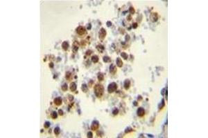 Formalin fixed, paraffin embedded human lung tissue stained with TBXAS1 Antibody  followed by peroxidase conjugation of the secondary antibody and DAB staining. (TBXAS1 Antikörper  (Middle Region))