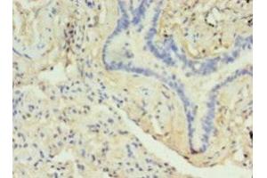 Immunohistochemistry of paraffin-embedded human lung cancer using ABIN7149470 at dilution of 1:100