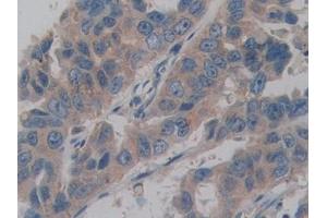 IHC-P analysis of Human Breast cancer Tissue, with DAB staining.