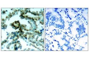 Immunohistochemical analysis of paraffin-embedded human lung carcinoma tissue, using PKCβ (phospho-Thr641) antibody (E011172). (PKC beta Antikörper  (pThr641))