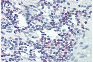 Human Colon, Lymphocytes (formalin-fixed, paraffin-embedded) stained with PLCG1 antibody ABIN337039 at 1:25-1:100 followed by biotinylated goat anti-rabbit IgG secondary antibody ABIN481713, alkaline phosphatase-streptavidin and chromogen. (Phospholipase C gamma 1 Antikörper  (C-Term))