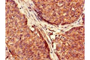 Immunohistochemistry of paraffin-embedded human ovarian cancer using ABIN7174352 at dilution of 1:100 (USP6 Antikörper  (C-Term))