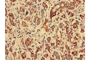 Immunohistochemistry analysis of human breast cancer using ABIN7168269 at dilution of 1:100 (RTCD1 Antikörper  (AA 167-379))