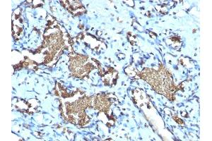 Formalin-fixed, paraffin-embedded human Angiosarcoma stained with Glycophorin A Rabbit Recombinant Monoclonal Antibody (GYPA/1725R). (Rekombinanter CD235a/GYPA Antikörper)