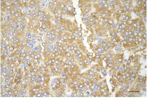Immunohistochemistry was performed on paraffin-embedded human hepatocarcinoma using dihydropyrimidine dehydrogenase antibody (ABIN7798341), 1:200).