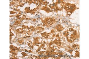 Immunohistochemistry of Human breast cancer using CPB1 Polyclonal Antibody at dilution of 1:50 (CPB1 Antikörper)