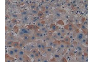 Detection of PADI4 in Human Liver cancer Tissue using Polyclonal Antibody to Peptidyl Arginine Deiminase Type IV (PADI4)