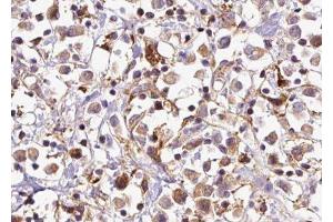 ABIN6277670 at 1/100 staining Human breast cancer tissue by IHC-P. (CTNNA1 Antikörper  (Internal Region))