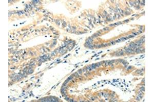 The image on the left is immunohistochemistry of paraffin-embedded Human colon cancer tissue using ABIN7131272(SYT5 Antibody) at dilution 1/15, on the right is treated with fusion protein. (Synaptotagmin V Antikörper)