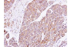 IHC-P Image Immunohistochemical analysis of paraffin-embedded human endometrial cancer, using cGK1, antibody at 1:500 dilution. (PRKG1 Antikörper  (Center))