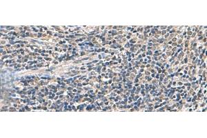 Immunohistochemistry of paraffin-embedded Human cervical cancer tissue using ATP5F1D Polyclonal Antibody at dilution of 1:55(x200) (ATP5F1D Antikörper)