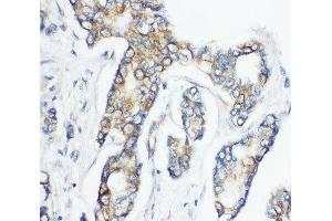 IHC-P: CD1d antibody testing of human breast cancer tissue (CD1d Antikörper  (AA 76-92))