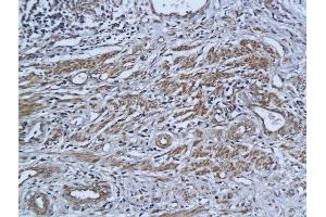 Formalin-fixed and paraffin embedded human cervical cancer labeled with Anti-ADAR1 (N-terminus) Polyclonal Antibody, Unconjugated followed by conjugation to the secondary antibody and DAB staining (ADAR Antikörper  (AA 151-250))