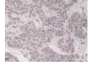 DAB staining on IHC-P;Samples:Human Pancreas Cancer Tissue) (ORM1 Antikörper  (AA 19-201))