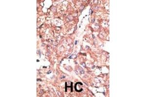 Formalin-fixed and paraffin-embedded human cancer tissue reacted with the primary antibody, which was peroxidase-conjugated to the secondary antibody, followed by DAB staining. (ATG4B Antikörper  (C-Term))