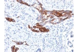 IHC staining of FFPE human gastric carcinoma with recombinant Gastric Mucin antibody (clone MUC6/1553R). (MUC6 Antikörper)