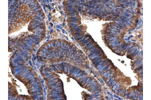 IHC-P Image ARFIP2 antibody [N1C2] detects ARFIP2 protein at cytoplasm in human endometrial cancer by immunohistochemical analysis. (ARFIP2 Antikörper)