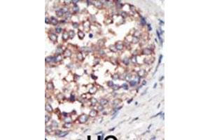 Formalin-fixed and paraffin-embedded human cancer tissue reacted with the primary antibody, which was peroxidase-conjugated to the secondary antibody, followed by AEC staining. (PIK3 gamma Antikörper  (C-Term))