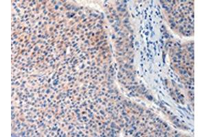 The image on the left is immunohistochemistry of paraffin-embedded Human liver cancer tissue using ABIN7190632(FAT4 Antibody) at dilution 1/20, on the right is treated with synthetic peptide. (FAT4 Antikörper)