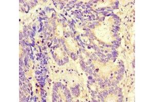 Immunohistochemistry of paraffin-embedded human colon cancer using ABIN7165797 at dilution of 1:100 (MAX Antikörper  (AA 1-58))