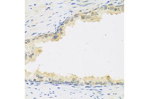 Immunohistochemistry of paraffin-embedded human prostate using LIF antibody (ABIN5974705) at dilution of 1/100 (40x lens). (LIF Antikörper)