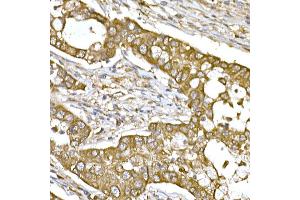 Immunohistochemistry of paraffin-embedded human lung cancer using β-Tubulin Rabbit pAb (ABIN3020552, ABIN3020553 and ABIN3020554) at dilution of 1:250 (40x lens). (TUBB Antikörper  (AA 40-260))