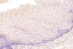 Immunohistochemistry analysis of paraffin-embedded human esophageal cancer using TBX10 (ABIN7075814) at dilution of 1: 4600 (T-Box 10 Antikörper)