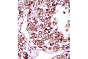 Formalin-fixed and paraffin-embedded human cancer tissue (hepatocarcinoma) reacted with the primary antibody, which was peroxidase-conjugated to the secondary antibody, followed by AEC staining. (CAMKII gamma Antikörper  (C-Term))