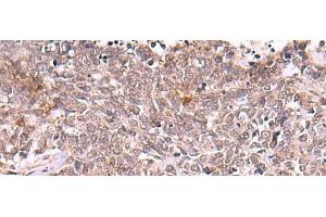 Immunohistochemistry of paraffin-embedded Human lung cancer tissue using TRMT12 Polyclonal Antibody at dilution of 1:80(x200) (TRMT12 Antikörper)