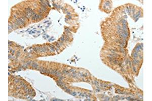 The image on the left is immunohistochemistry of paraffin-embedded Human colon cancer tissue using ABIN7191855(PGBD5 Antibody) at dilution 1/10, on the right is treated with synthetic peptide. (PGBD5 Antikörper)