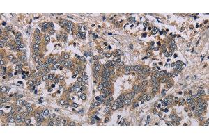 Immunohistochemistry of paraffin-embedded Human liver cancer tissue using AATK Polyclonal Antibody at dilution 1:45 (AATK Antikörper)