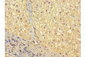 Immunohistochemistry of paraffin-embedded human liver cancer using ABIN7175557 at dilution of 1:100