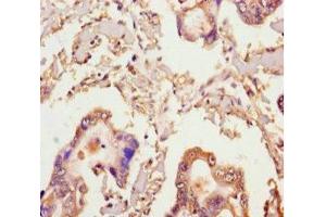 Immunohistochemistry of paraffin-embedded human pancreatic cancer using ABIN7141994 at dilution of 1:100 (MICAL2 Antikörper  (AA 1-495))