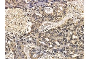 AurB Mouse Monoclonal Antibody at 1/100 staining human lung cancer and adjacent non-tumor tissue by IHC-P. (Aurora Kinase B Antikörper  (N-Term))