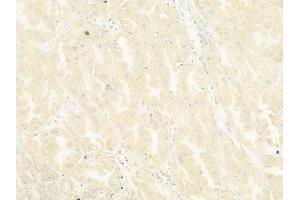 ABIN6265620 and ABIN6278644 at 1/100 staining human renal cell carcinoma by IHC-P.