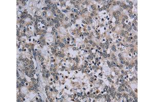 Immunohistochemistry of Human lung cancer using TP53AIP1 Polyclonal Antibody at dilution of 1:50