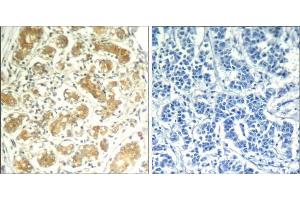 Immunohistochemical analysis of paraffin-embedded human breast carcinoma tissue using syk (Ab-323) Antibody (E021546). (SYK Antikörper)
